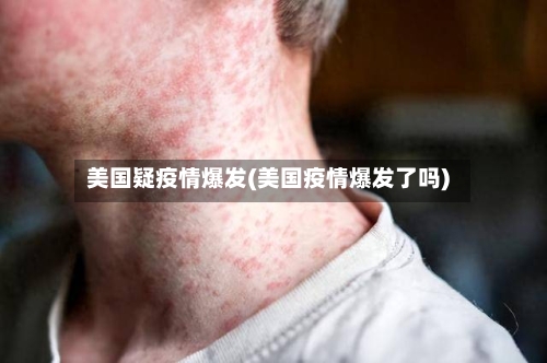 美国疑疫情爆发(美国疫情爆发了吗)