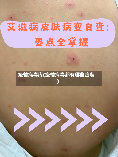 疫情病毒库(疫情病毒都有哪些症状)-第2张图片