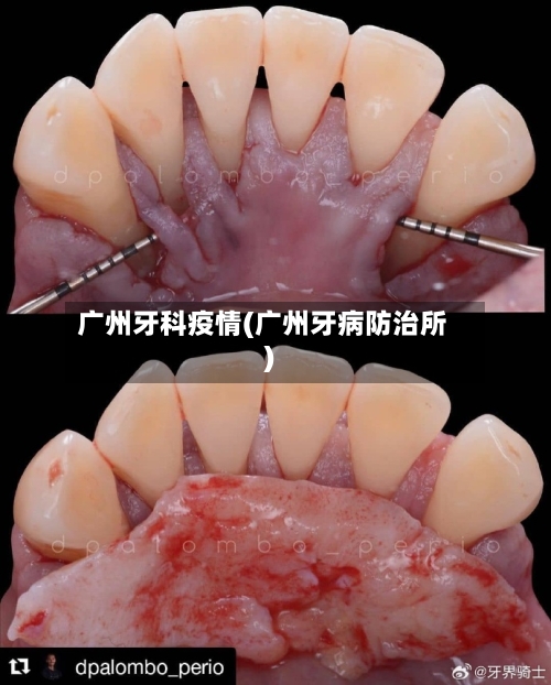 广州牙科疫情(广州牙病防治所)